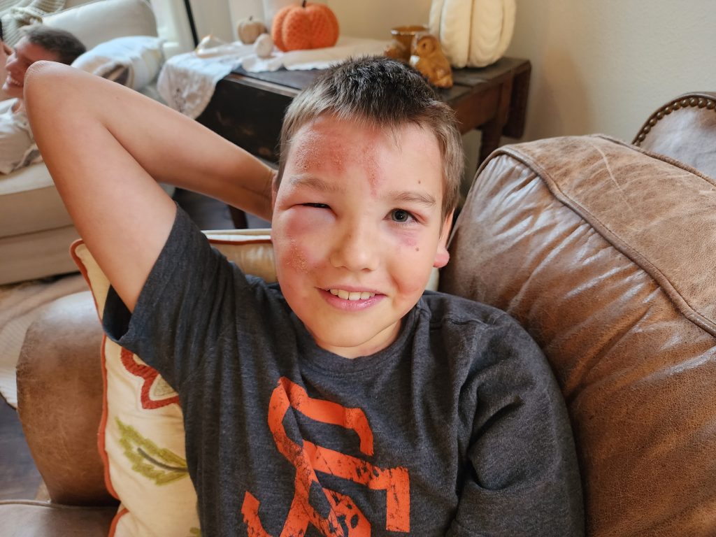 The day I got poison oak